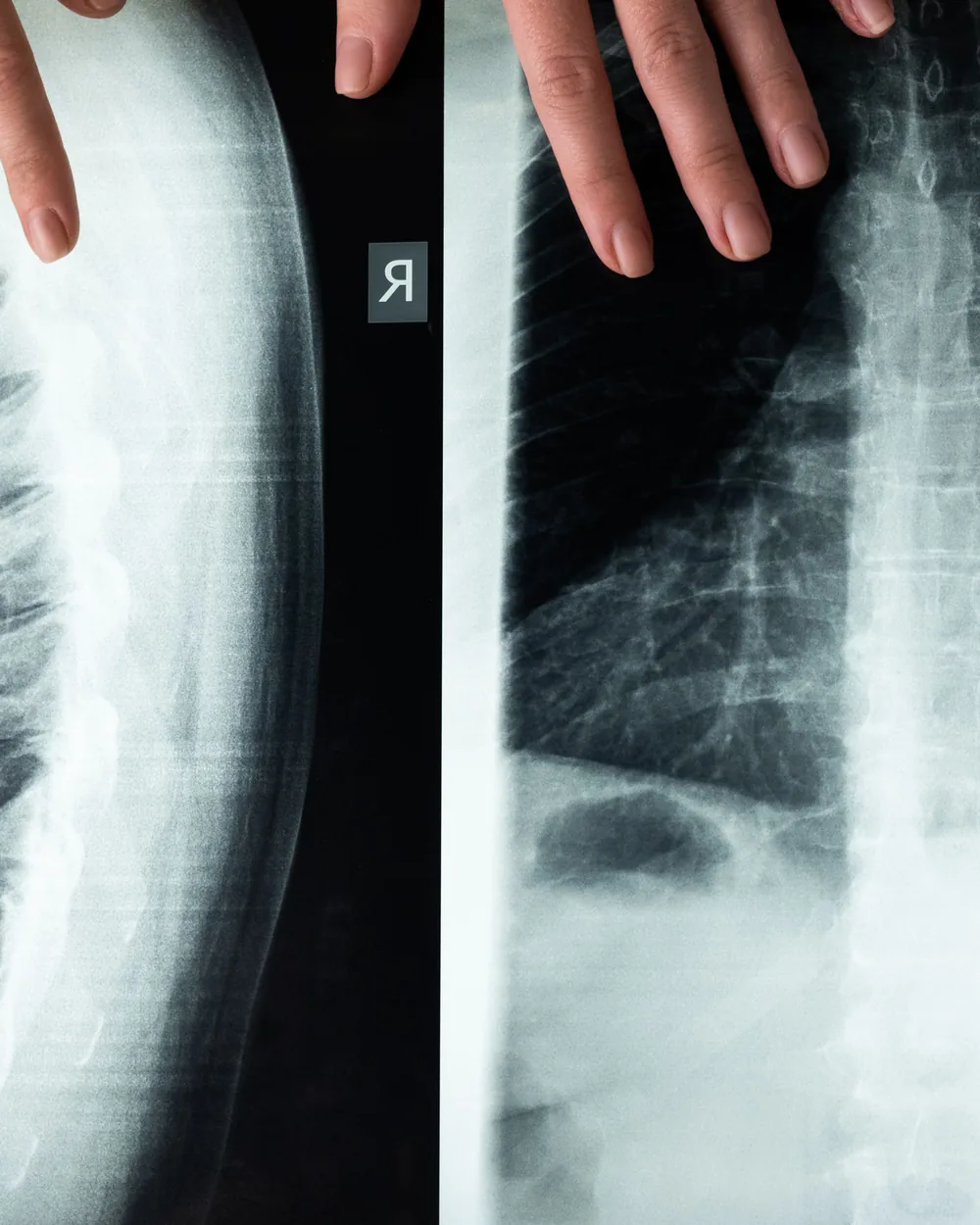 Hands holding medical images of a spine for review