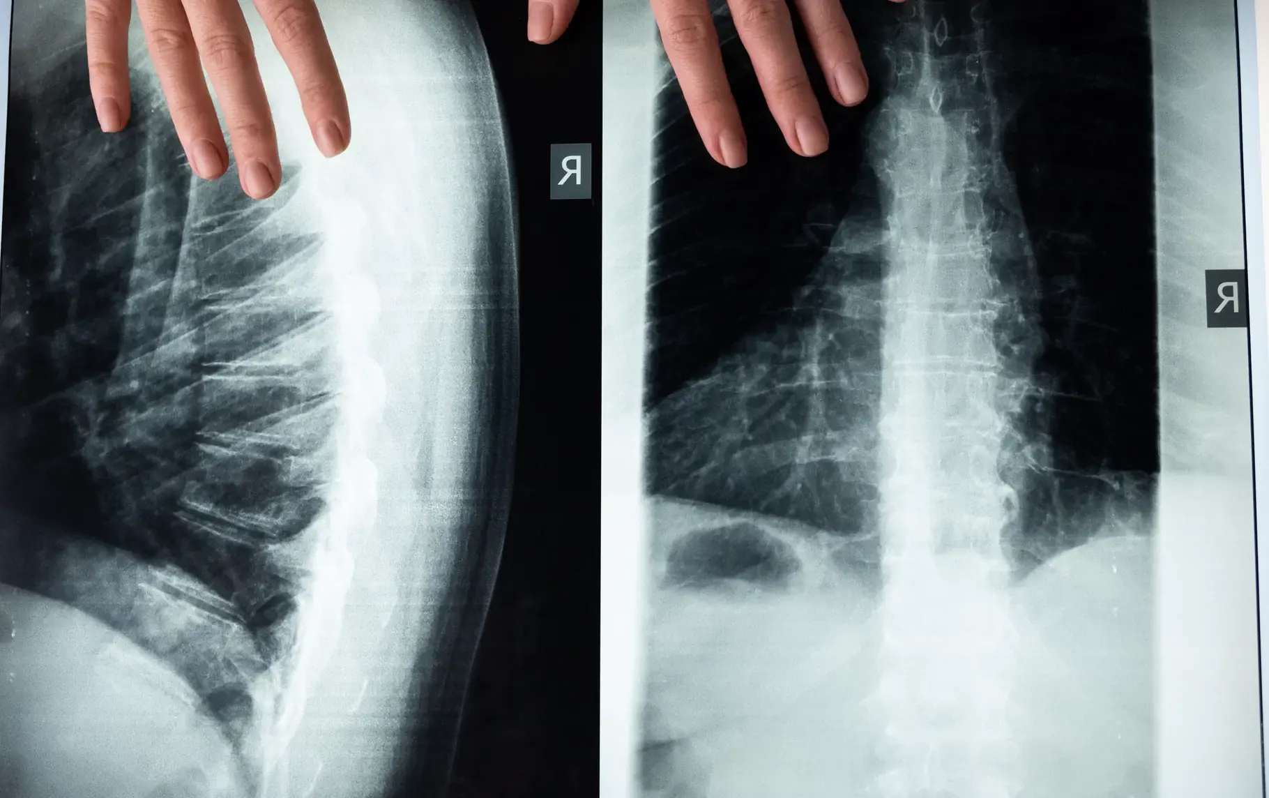 Hands holding two spinal X-ray films for medical review